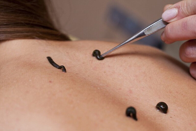 Пиявки и их роль Пиявки и их роль